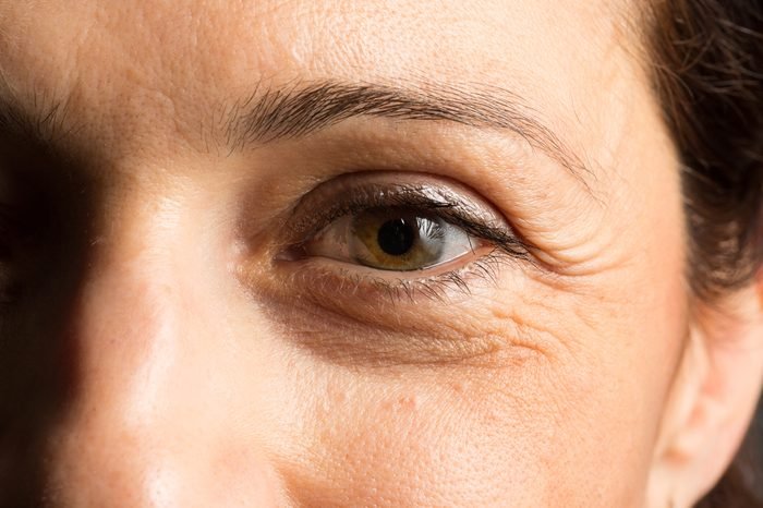 قرص هیالورونیک اسید برای چین و چروک